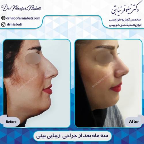 جراحی بینی 1