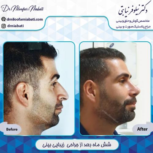 جراحی بینی 10
