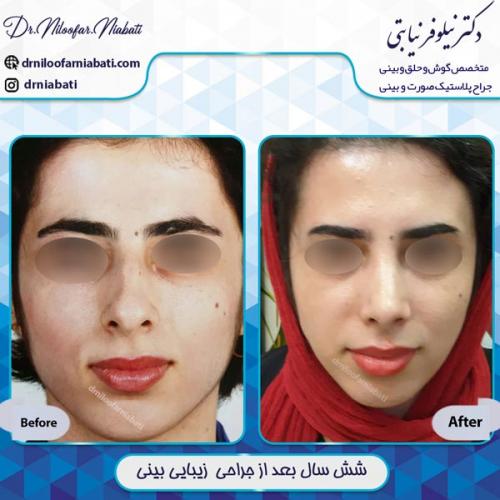 جراحی بینی 11