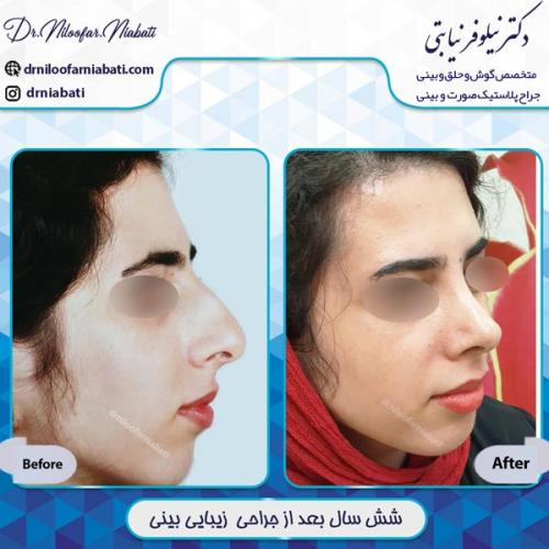 جراحی بینی 13