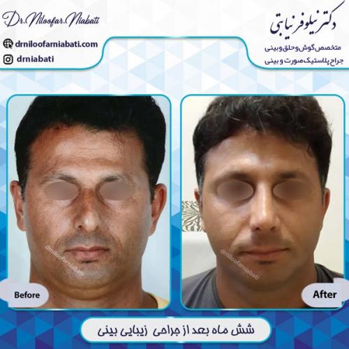 جراحی بینی 14