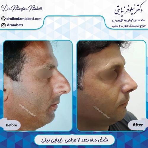 جراحی بینی 15