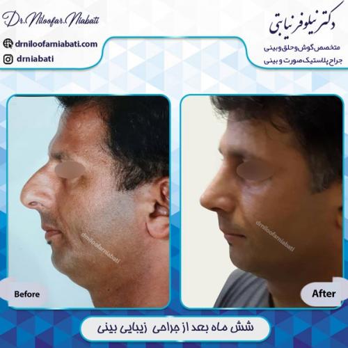 جراحی بینی 16