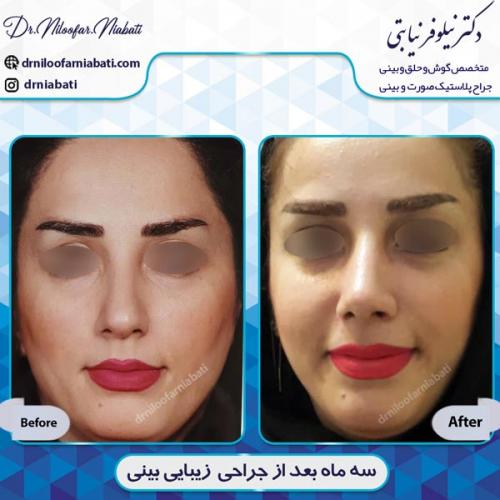 جراحی بینی 2