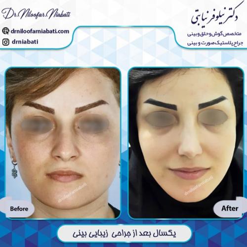 جراحی بینی 3