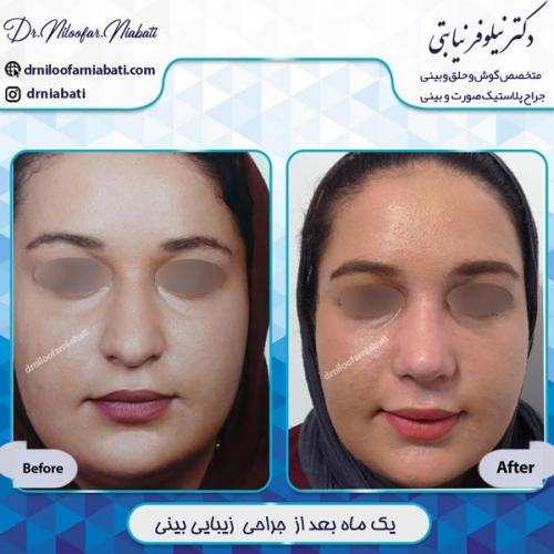 جراحی بینی 6