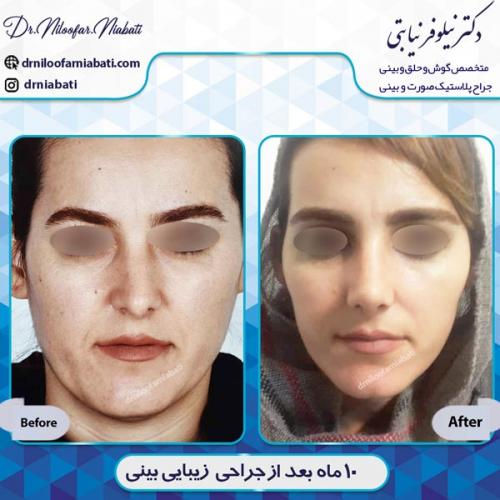 جراحی بینی 7