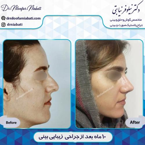 جراحی بینی 8