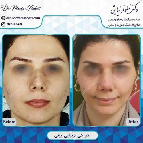 جراحی-بینی-200
