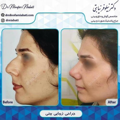 جراحی-بینی-202