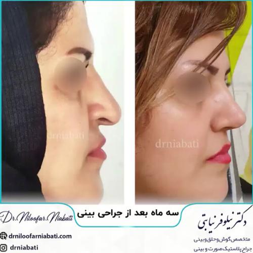 جراحی-بینی-204