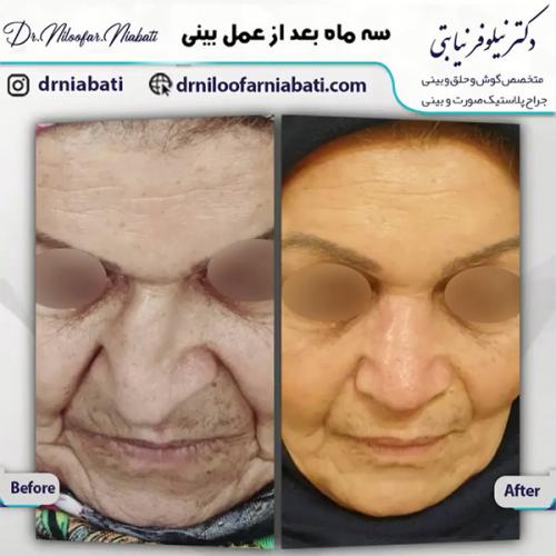 جراحی-بینی-205