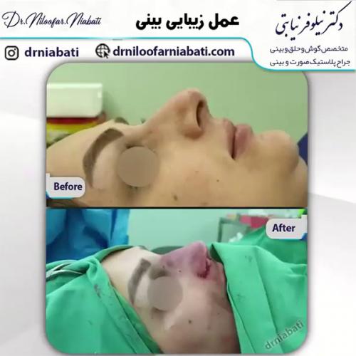 جراحی-بینی-207